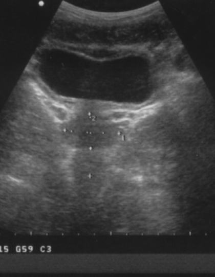 echographie prostate echographie prostate